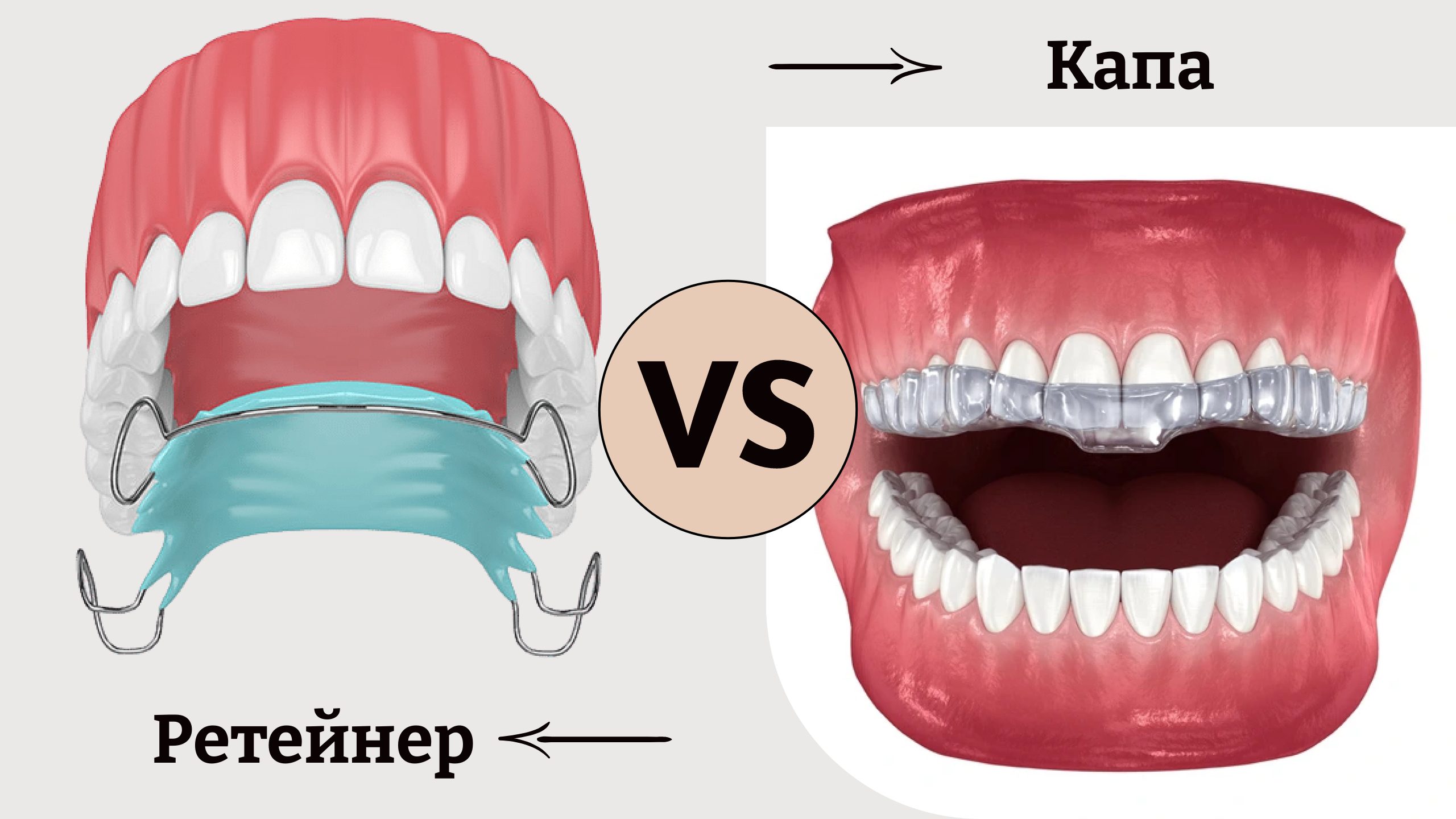 Ретейнеры и капы