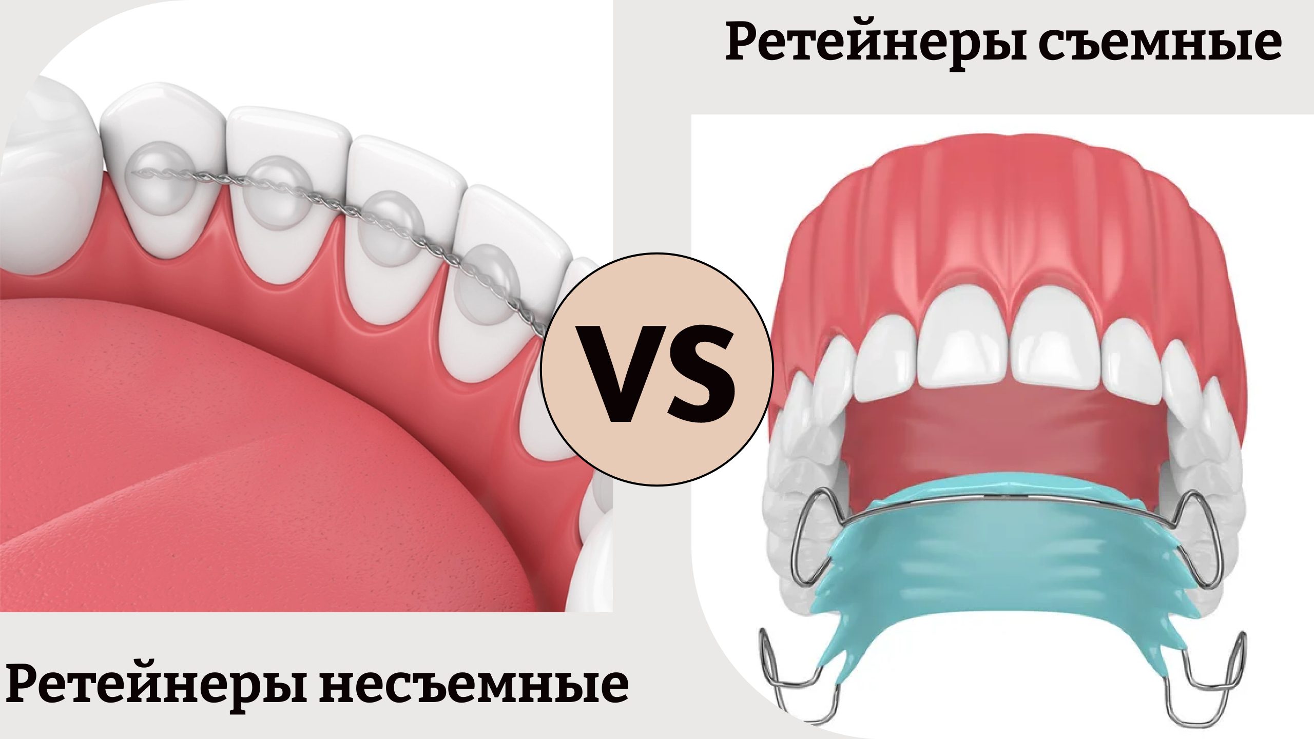 ретейнеры несъёмные и съёмные