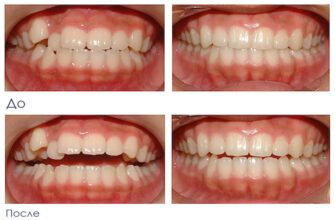 Результат исправления прикуса брекетами до и после
