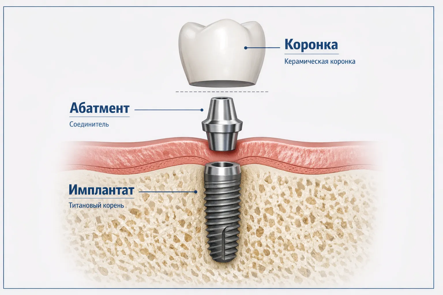 Строение зубного импланта: коронка, абатмент, имплантат, кость челюсти
