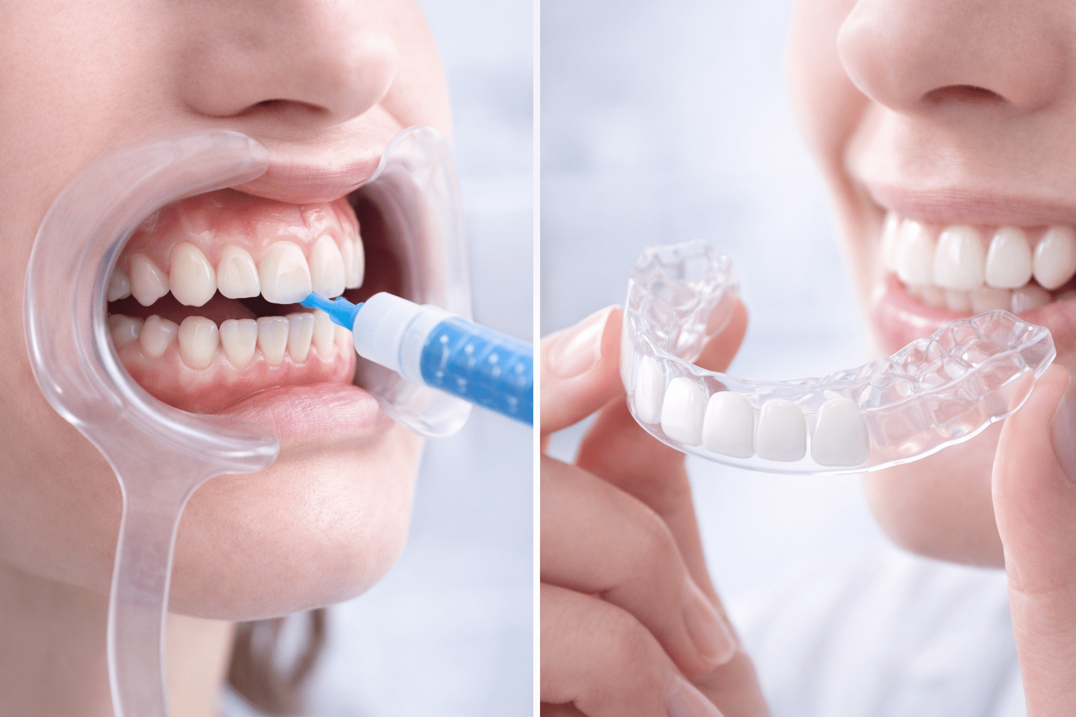 Сравнение методов отбеливания зубов: офисное и домашнее под контролем врача